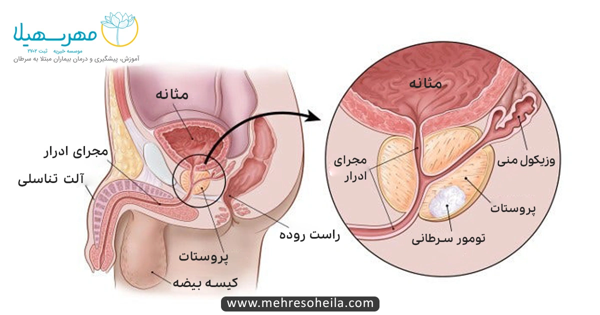 Prostate Cancer Img سرطان پروستات چیست