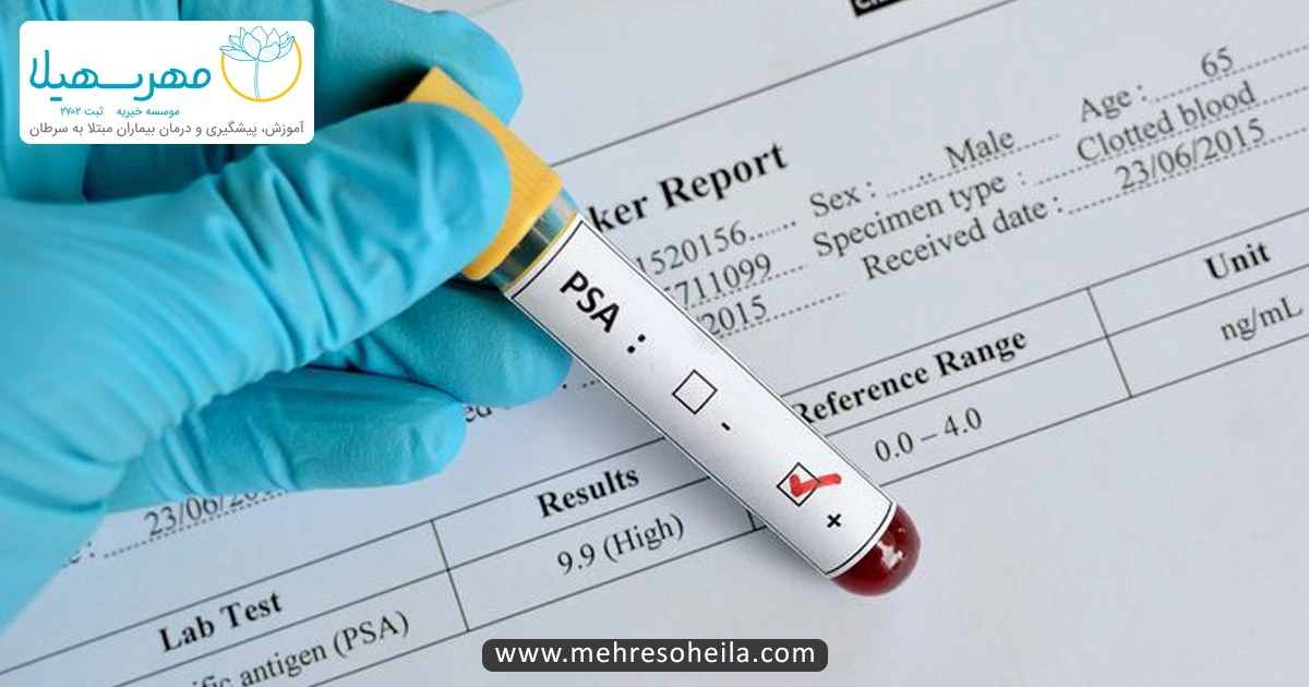 Prostate Cancer Img غربالگری سرطان پروستات