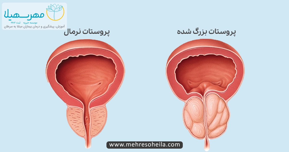 Prostate Cancer Img سرطان پروستات خوش خیم چیست