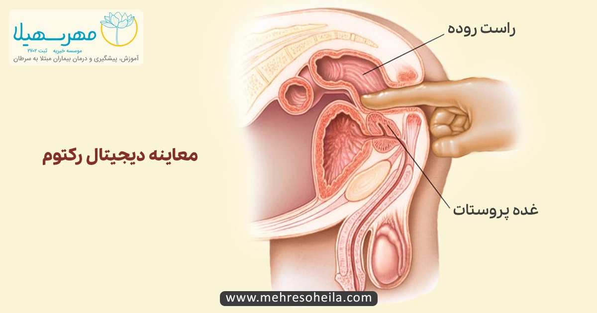 Prostate Cancer Img معاینه دیجیتال رکتوم