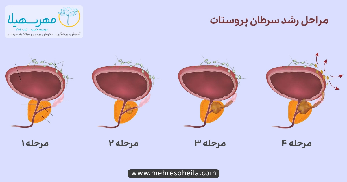 Prostate Cancer Img گرید بندی سرطان پروستات
