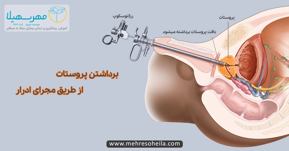 Prostate Cancer Img درمان سرطان پروستات