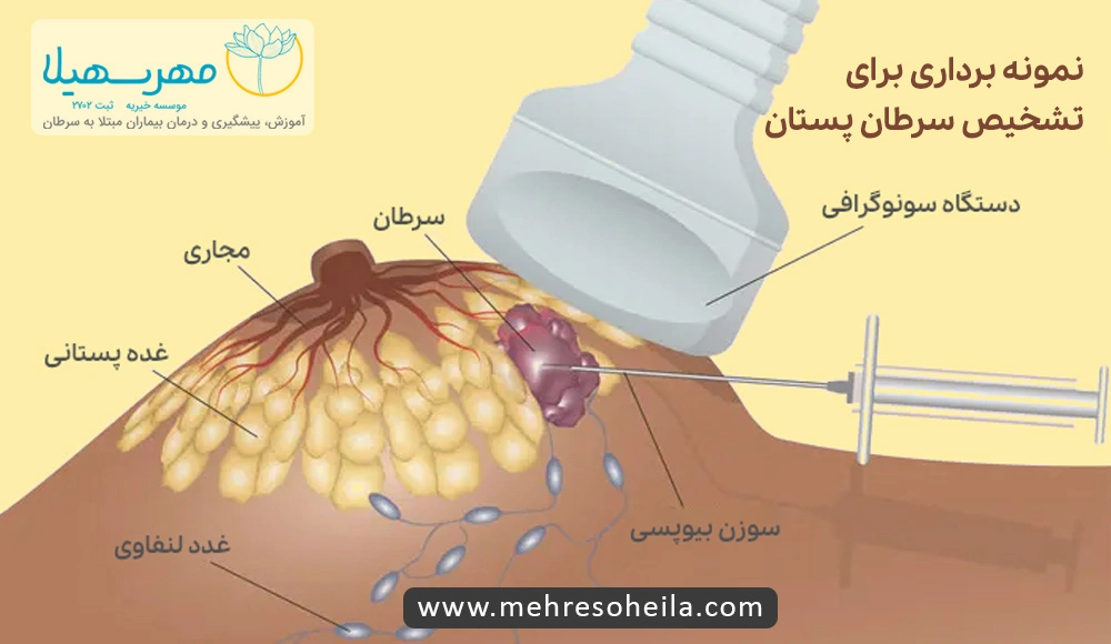 Breast Cancer MSb نمونه برداری از سرطان سینه