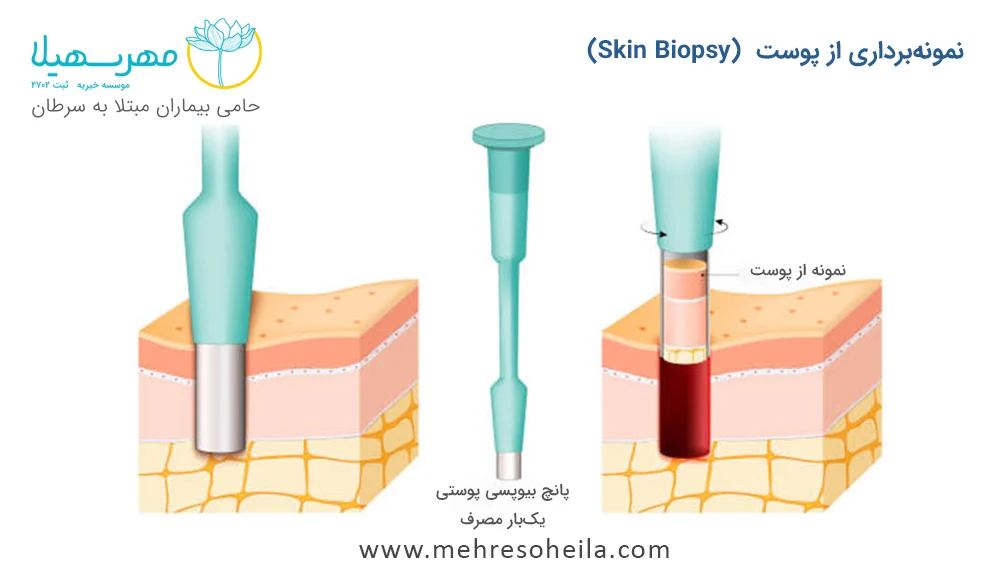 نمونه برداری از پوست