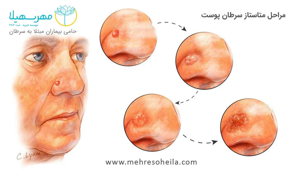 مراحل پیشرفت سرطان پوست