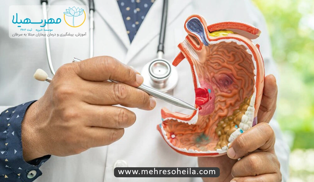 Stomach Cancer MS سرطان معده