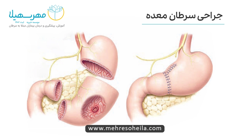 Stomach Cancer MS جراحی سرطان معده