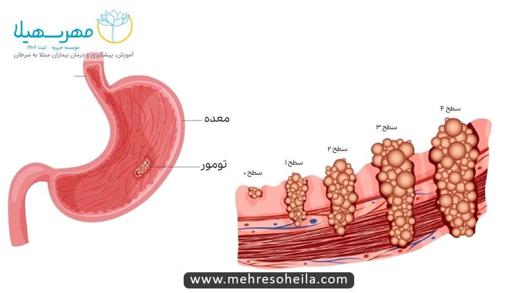 Stomach Cancer MS سطح بندی سرطان معده