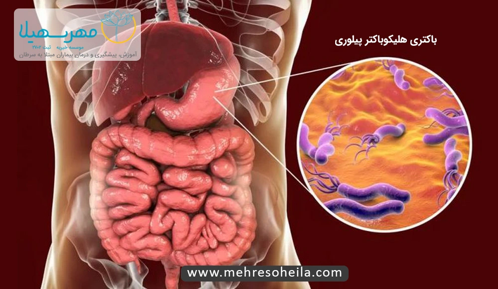 Stomach Cancer MS باکتری هلیکوباکتر پیلوری