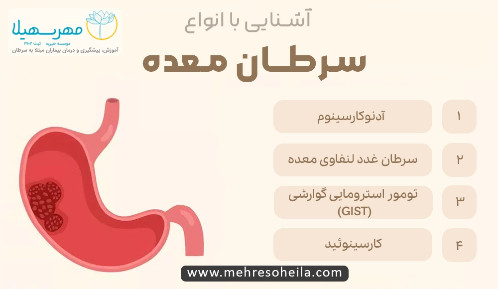 Stomach Cancer MS انواع سرطان معده