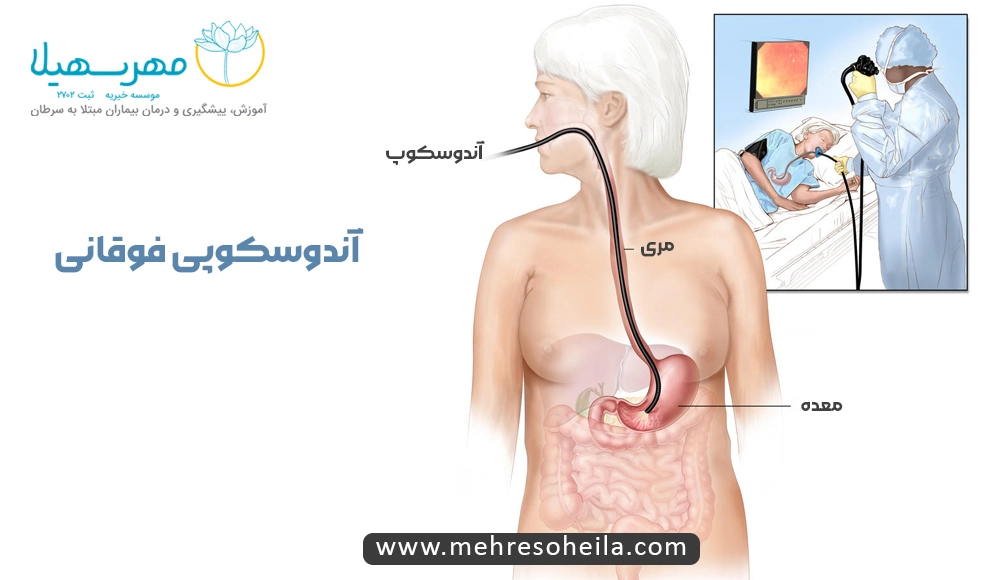 Stomach Cancer MS تشخیص سرطان معده