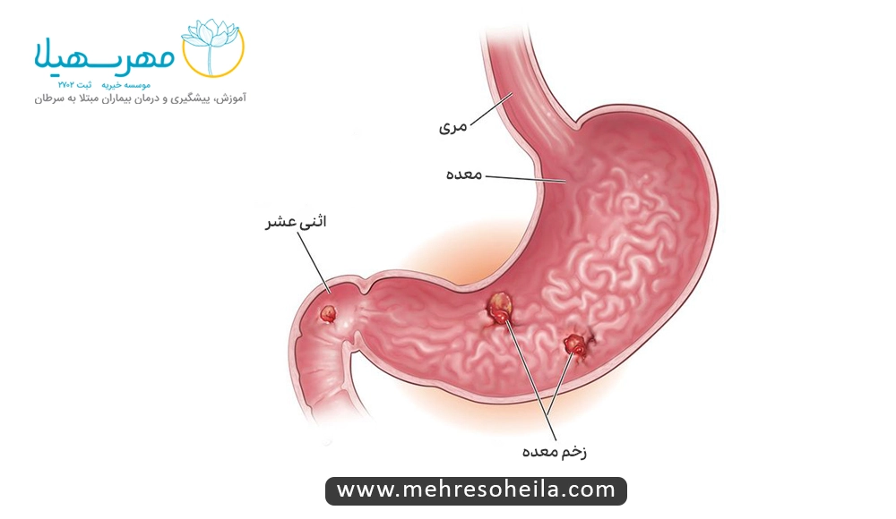Stomach Cancer MS زخم معده