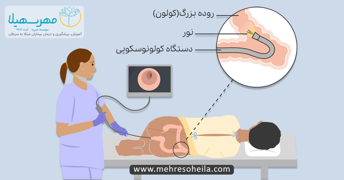 Bowel Cancer MSb کولونوسکوپی برای سرطان روده