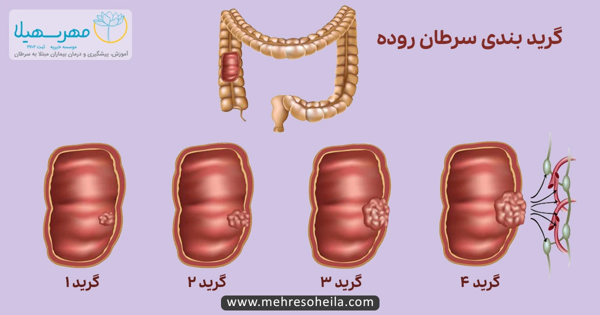 Bowel Cancer MSb مراحل سرطان روده
