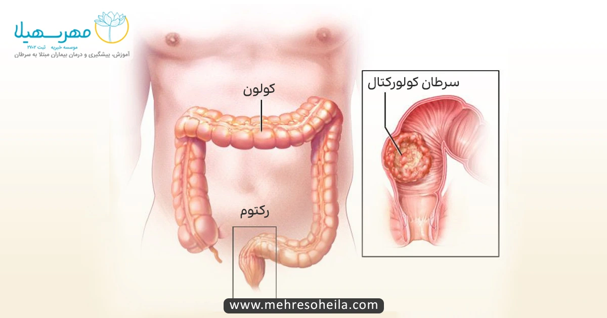Bowel Cancer MSb سرطان کولورکتال