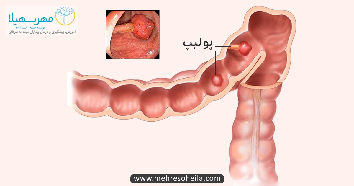 Bowel Cancer MSb پولیپ روده