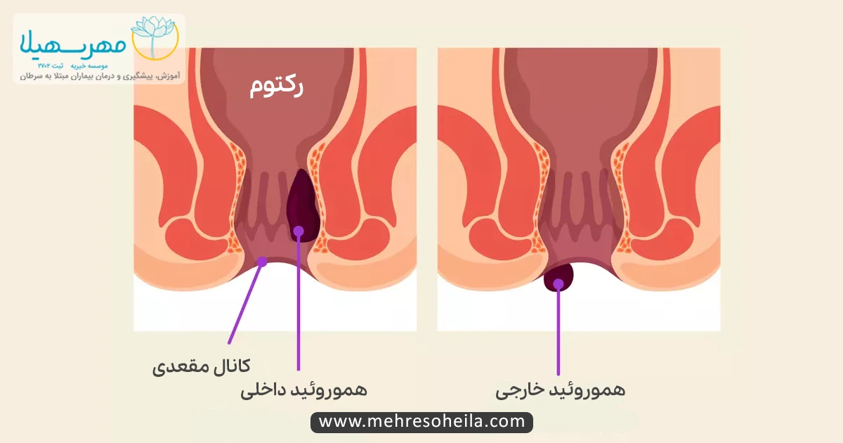 Bowel Cancer MSb هموروئید