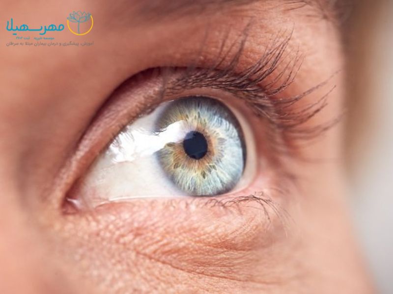 سرطان چشم و هر آنچه که باید در مورد ملانوم چشمی بدانید