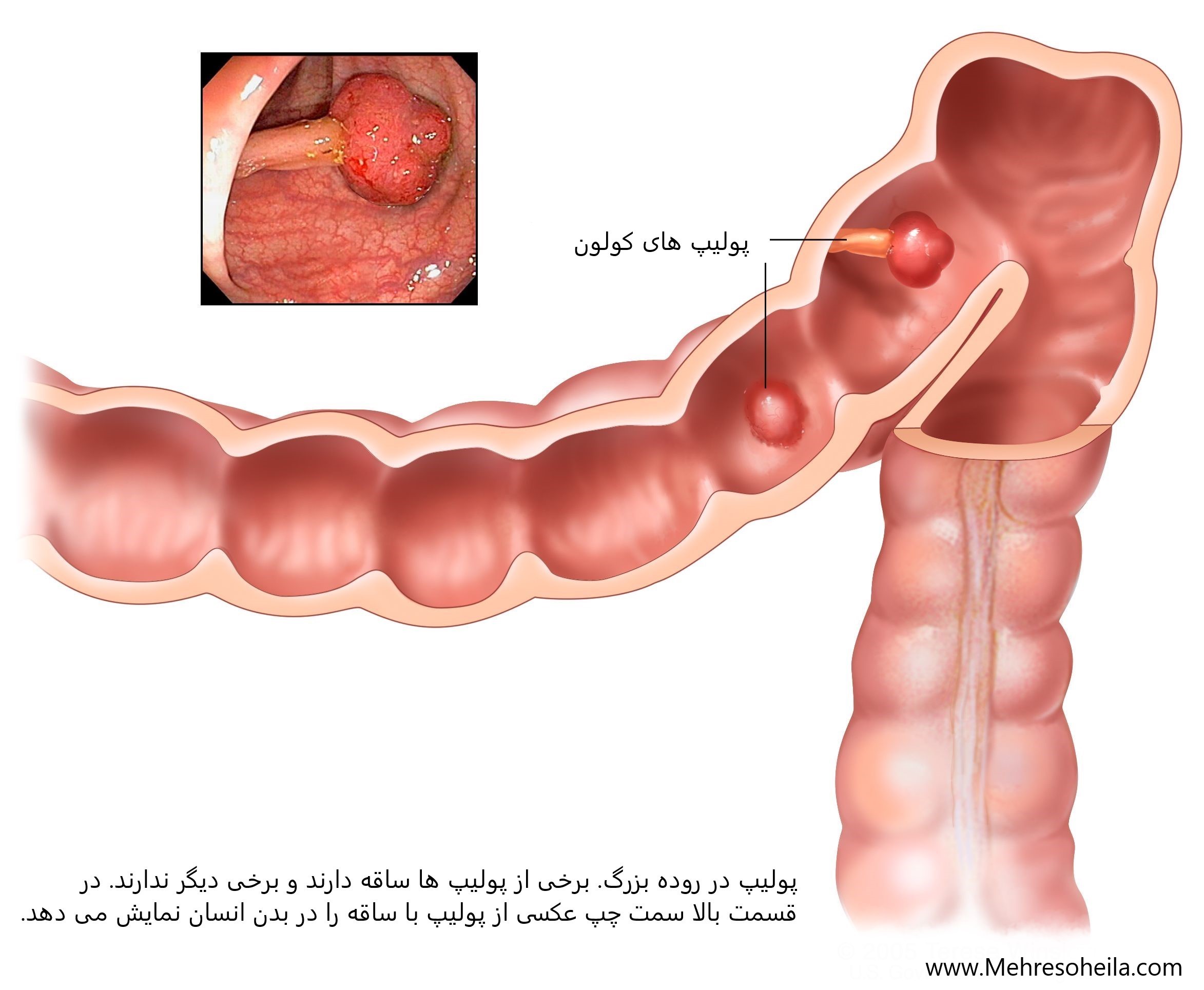 colon polyps پولیپ های کولون