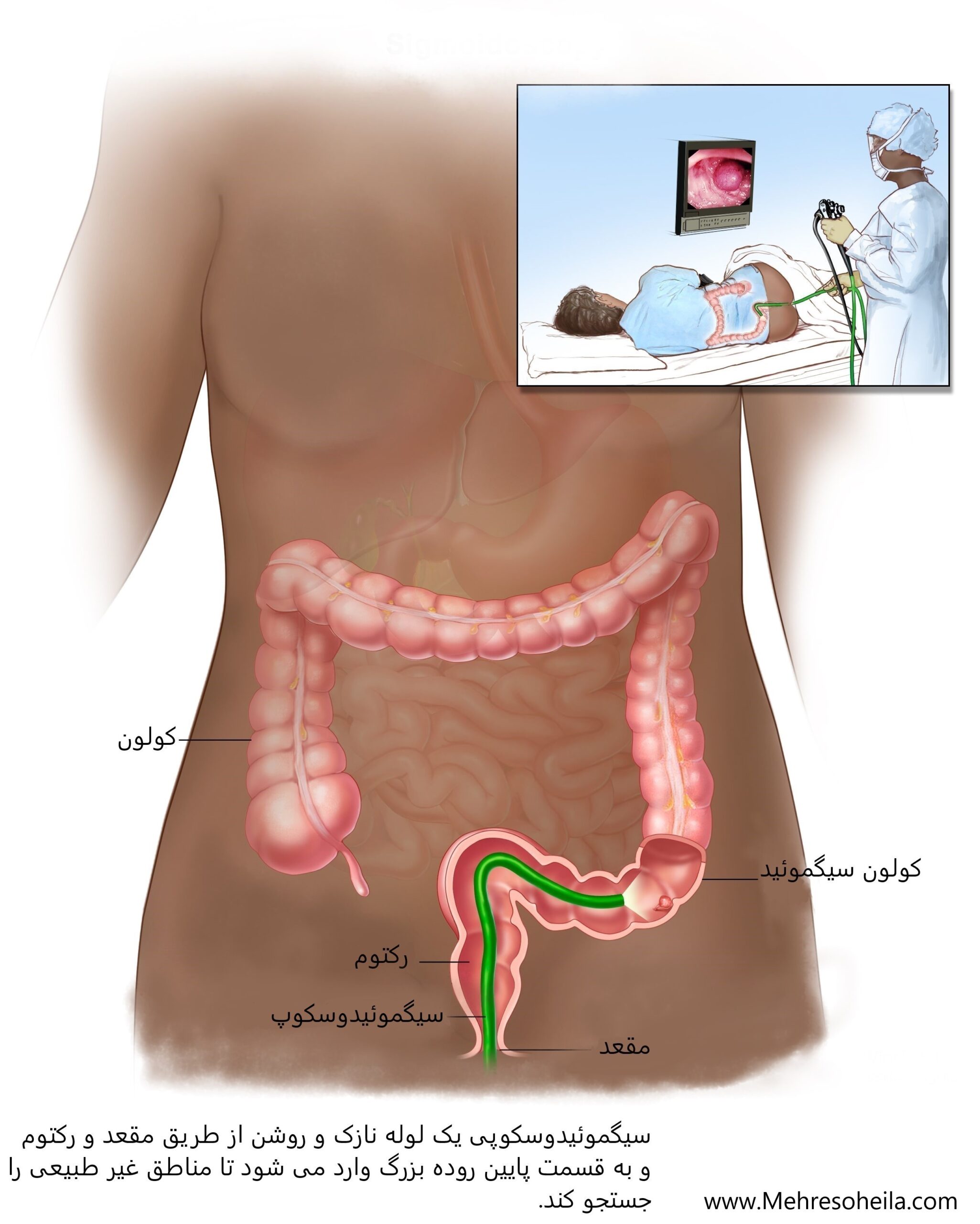سیگموئیدوسکپی