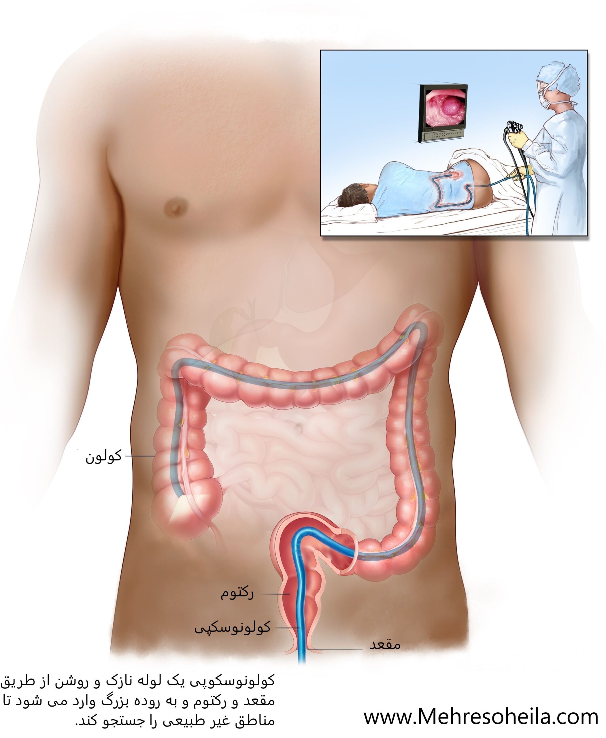 colonoscopy کولونوسکپی