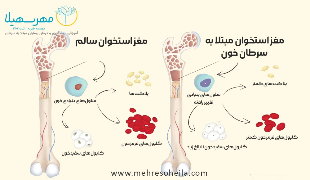 Leukemia Blog Img سرطان خون چگونه است