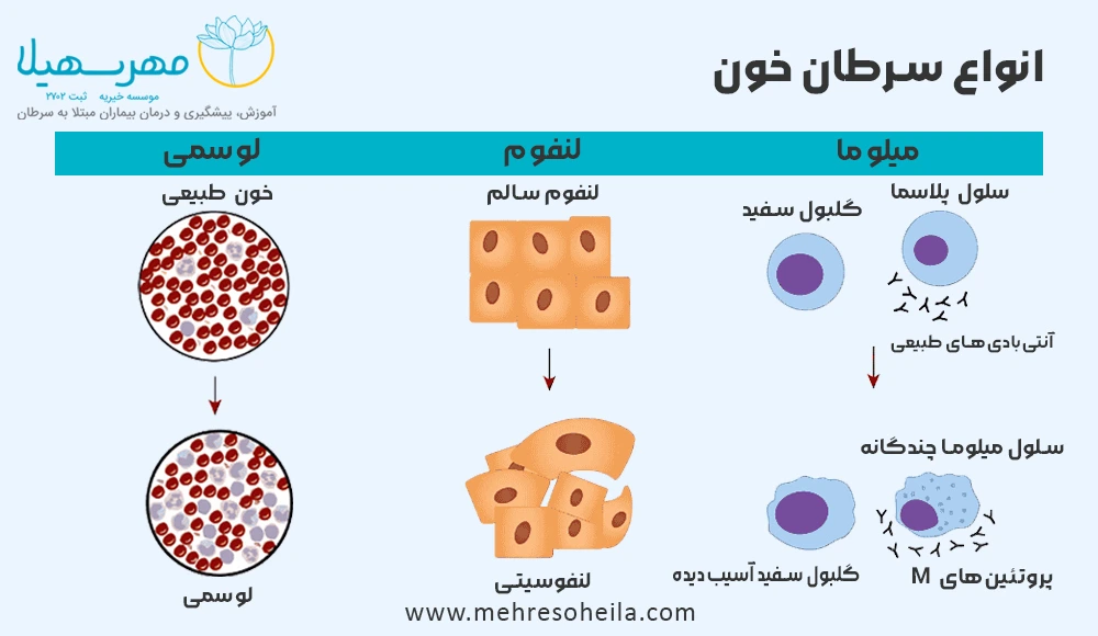 Leukemia Blog Img انواع سرطان خون