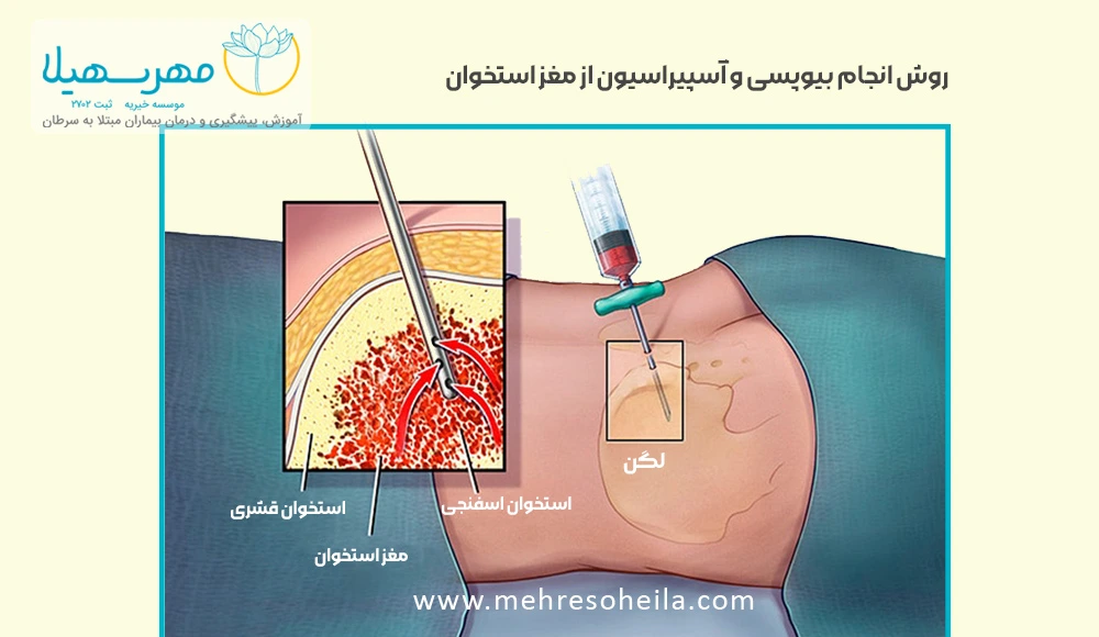 Leukemia Blog Img بیوپسی سرطان خون