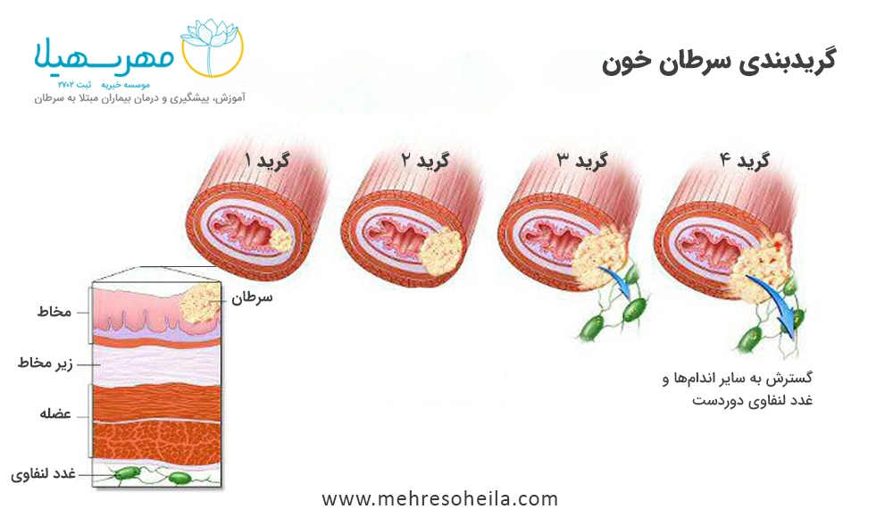 Leukemia Blog Img مراحل سرطان خون